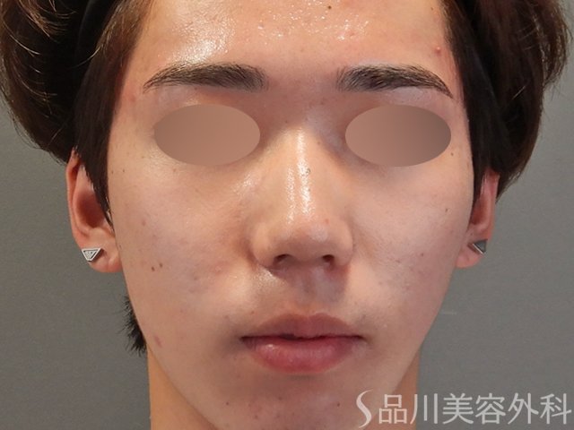 症例NO.74879のBEFORE写真