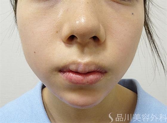 症例NO.52024のAFTER写真