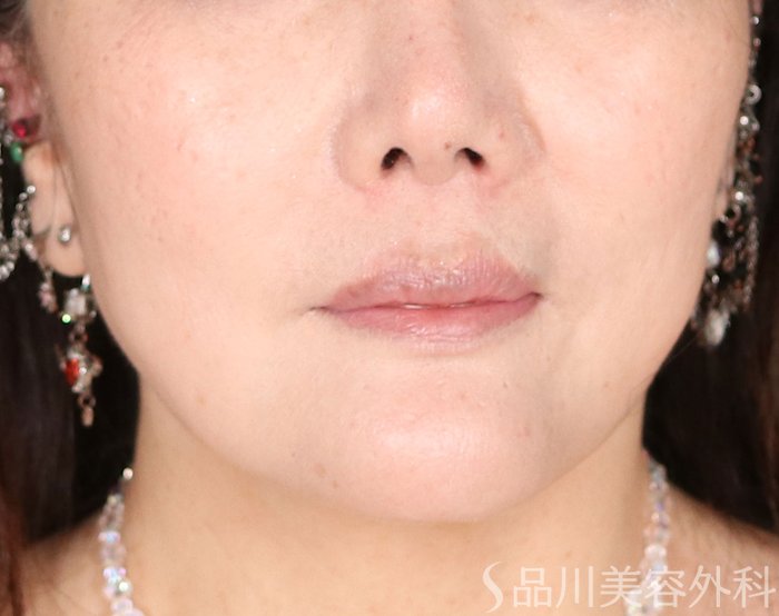 症例NO.72255のAFTER写真