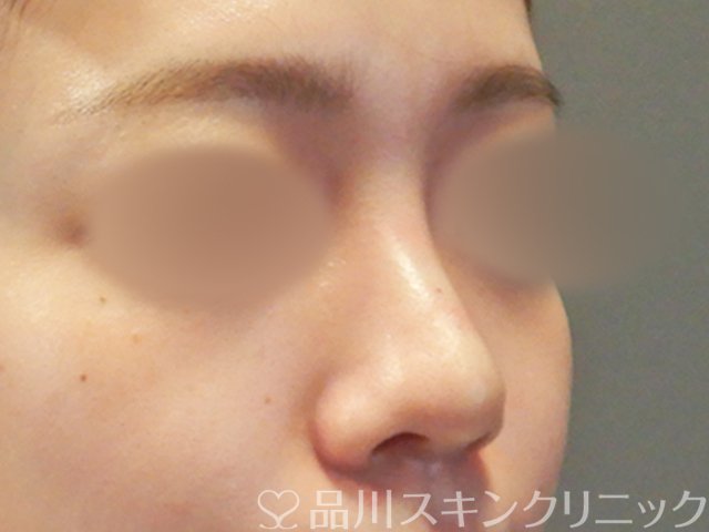 症例NO.65617のAFTER写真