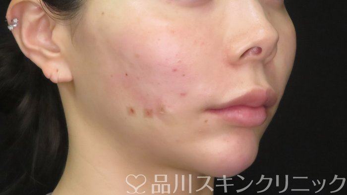 症例NO.70882のAFTER写真
