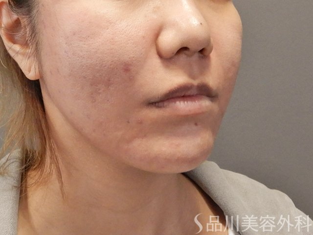 症例NO.74604のAFTER写真