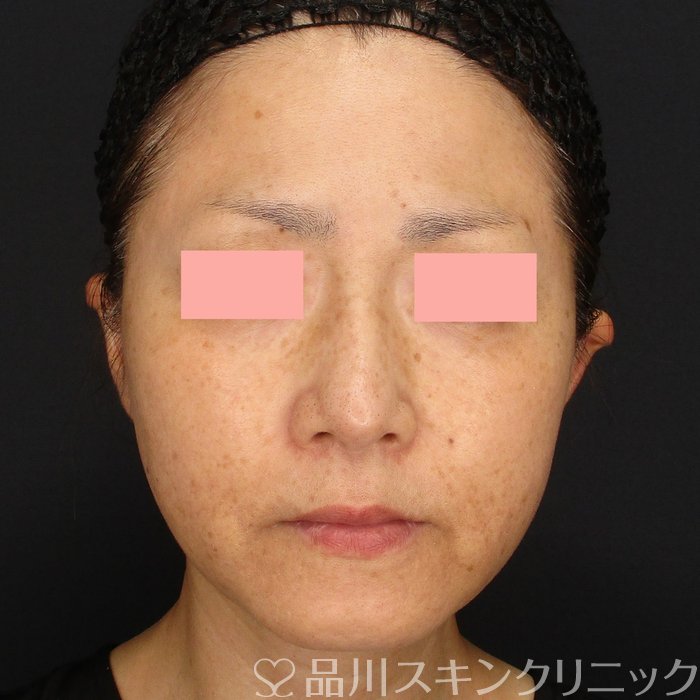 症例NO.72015のAFTER写真