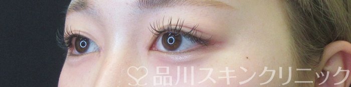 症例NO.68435のAFTER写真