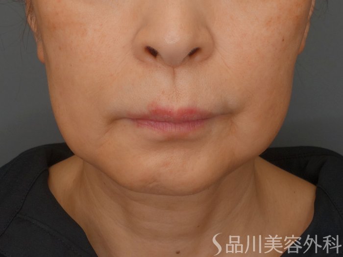 症例NO.65431のBEFORE写真