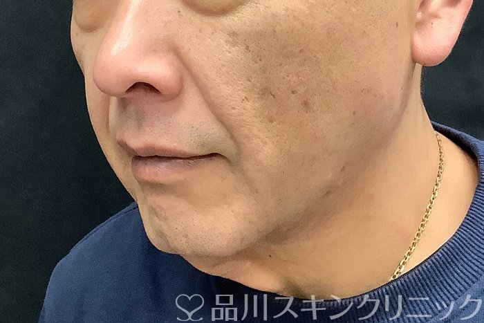 症例NO.69615のBEFORE写真