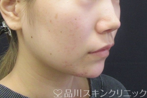 症例NO.66687のAFTER写真