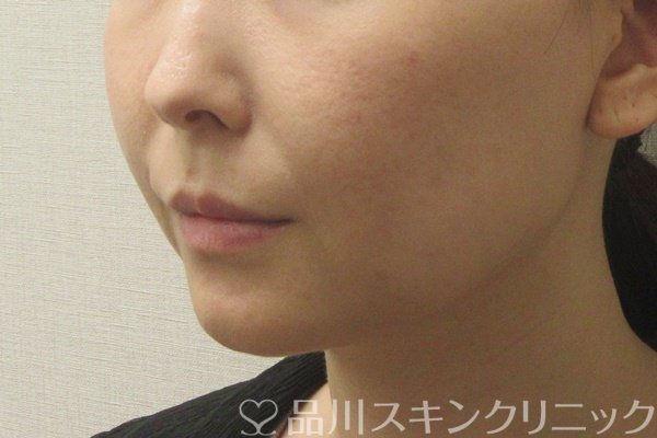 症例NO.72405のBEFORE写真