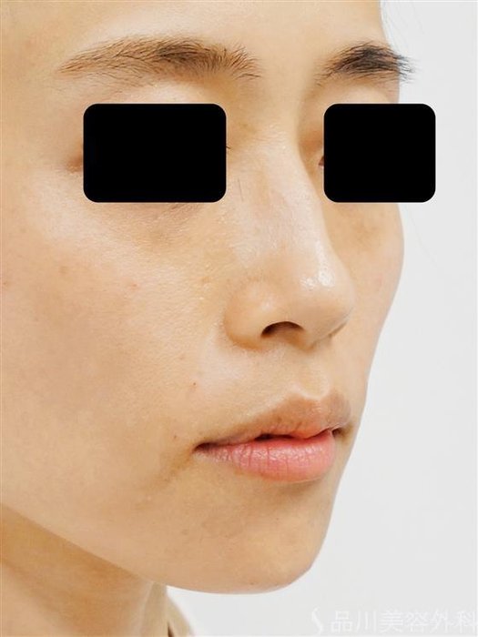 症例NO.34573のAFTER写真