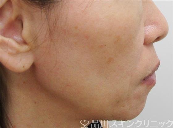 症例NO.42919のBEFORE写真