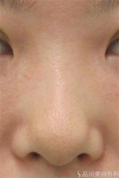 症例NO.20341のBEFORE写真