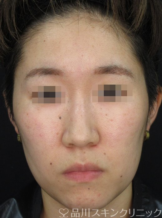 症例NO.72055のAFTER写真