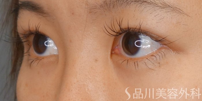 症例NO.64007のAFTER写真