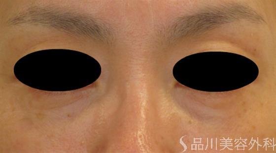症例NO.55707のAFTER写真