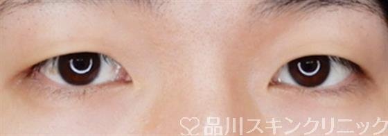 症例NO.58644のBEFORE写真