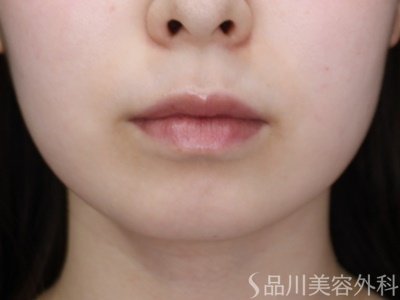症例NO.69636のBEFORE写真