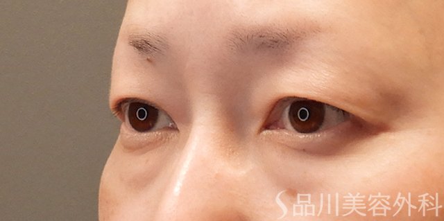 症例NO.74246のBEFORE写真