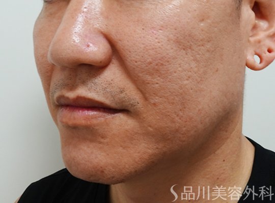 症例NO.73521のBEFORE写真