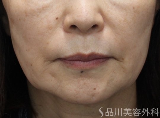 症例NO.74993のBEFORE写真
