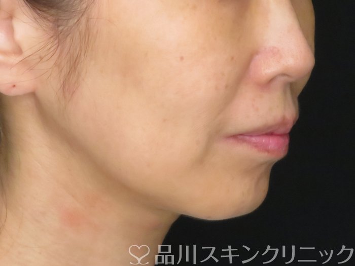 症例NO.65644のBEFORE写真