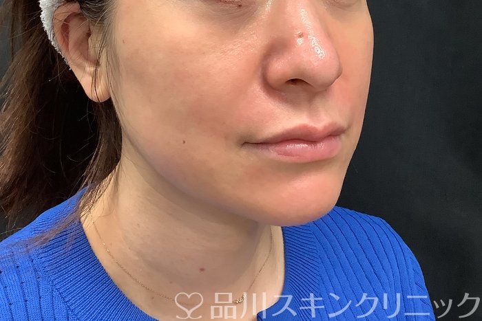 症例NO.71277のAFTER写真