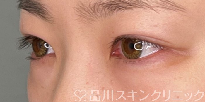 症例NO.69912のAFTER写真