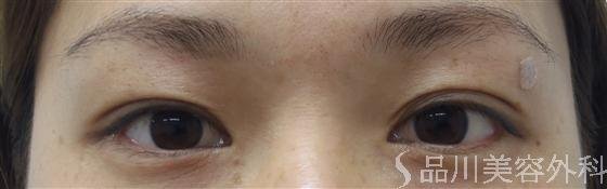 症例NO.12525のBEFORE写真
