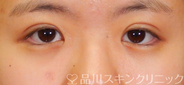 症例NO.66451のAFTER写真