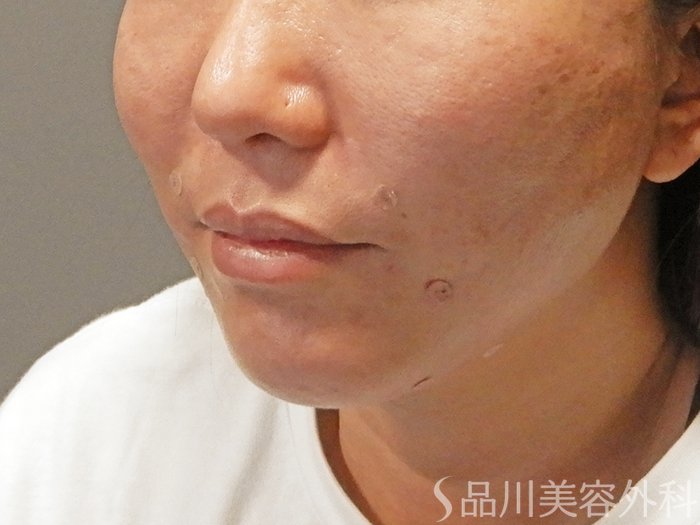 症例NO.69929のAFTER写真