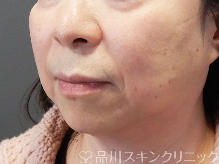 症例NO.72990のBEFORE写真