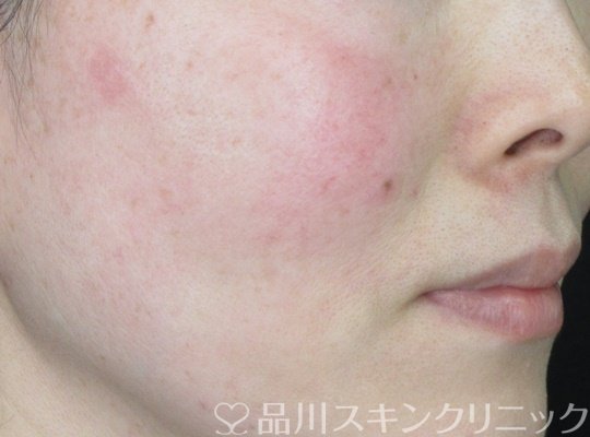 症例NO.69786のAFTER写真