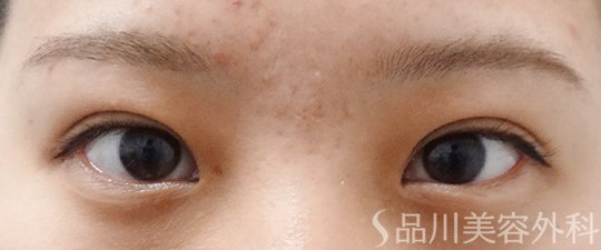 症例NO.62274のAFTER写真