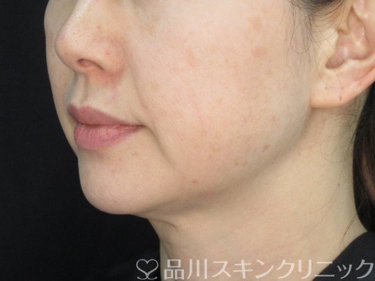 症例NO.72425のAFTER写真