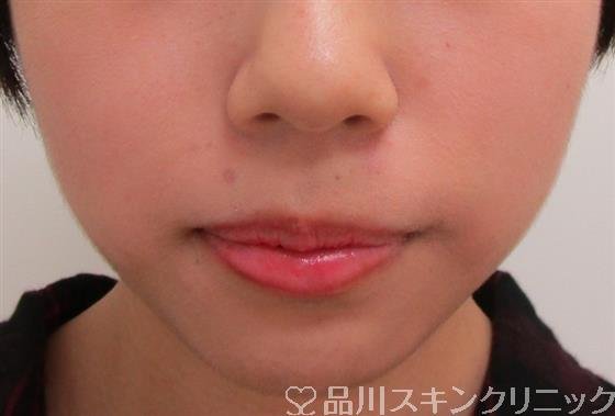 症例NO.30724のBEFORE写真