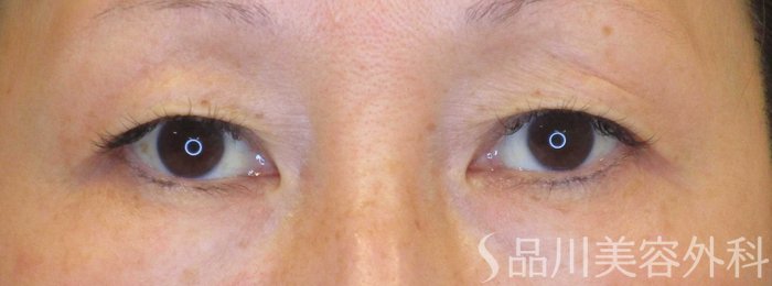 症例NO.69989のBEFORE写真