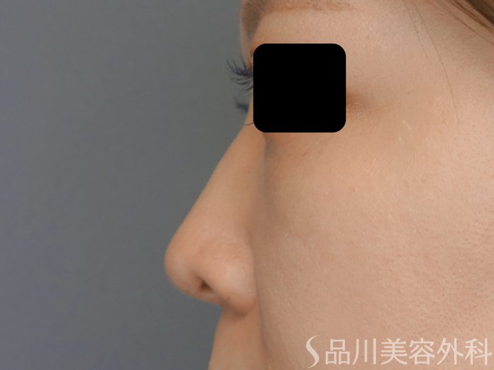 症例NO.71822のBEFORE写真