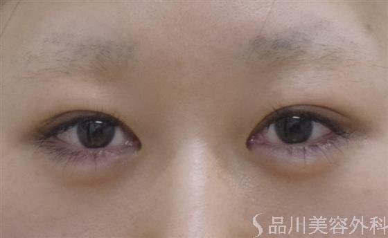 症例NO.52692のBEFORE写真