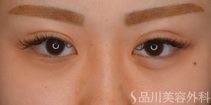 症例NO.73515のAFTER写真