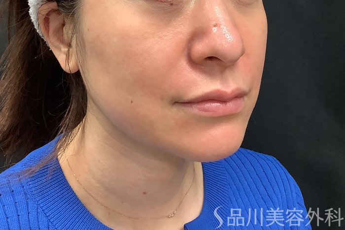 症例NO.71277のAFTER写真
