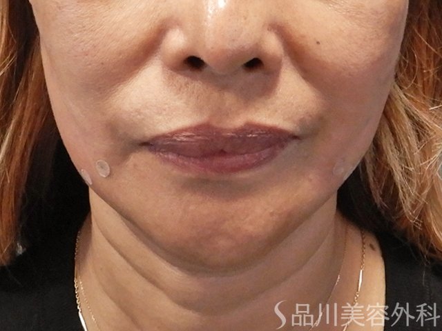 症例NO.72210のAFTER写真