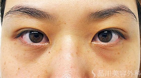 症例NO.21587のAFTER写真