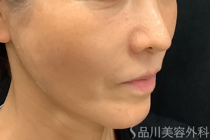 症例NO.71248のAFTER写真