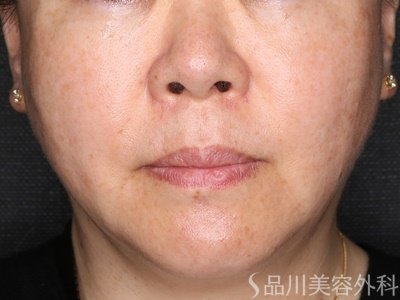 症例NO.72607のAFTER写真