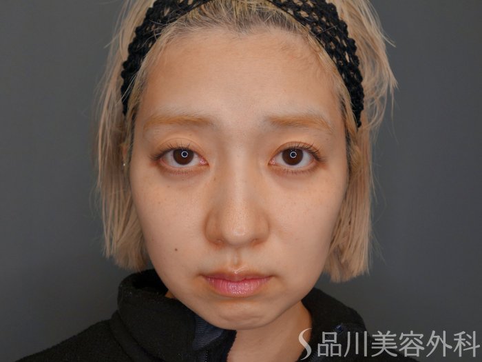 症例NO.65351のBEFORE写真