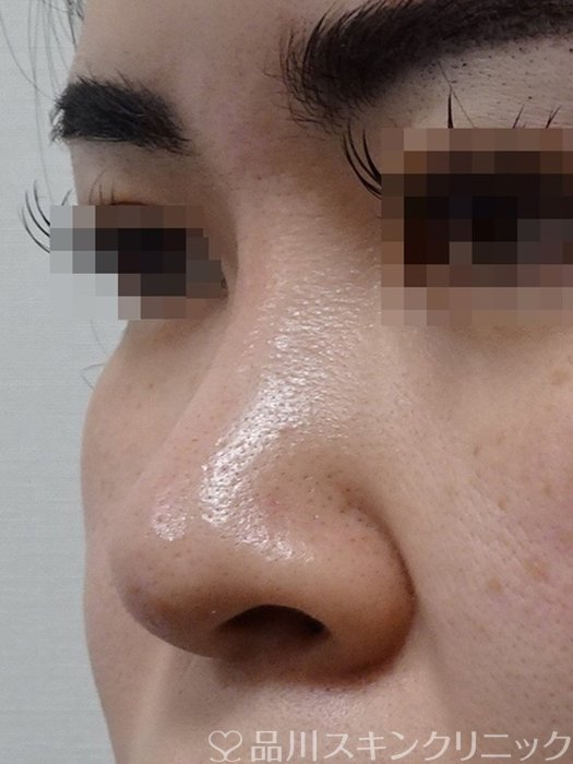 症例NO.70876のBEFORE写真