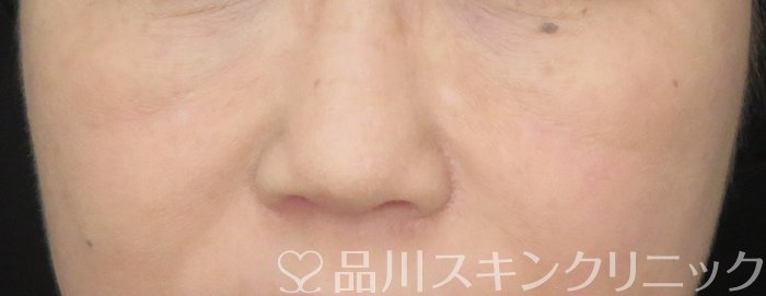 症例NO.65704のBEFORE写真