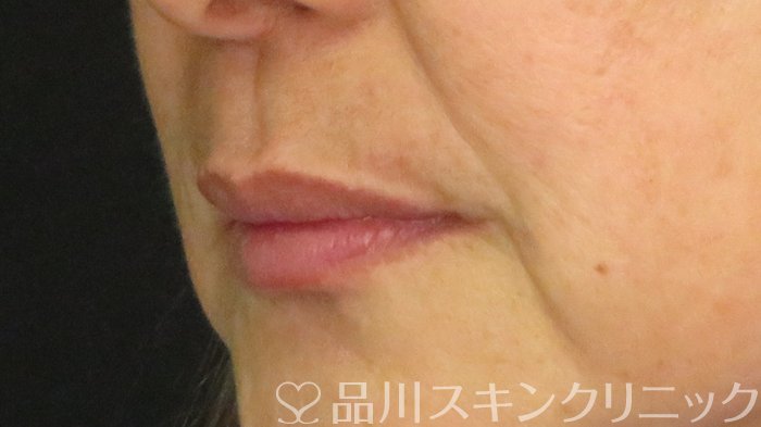 症例NO.70041のAFTER写真