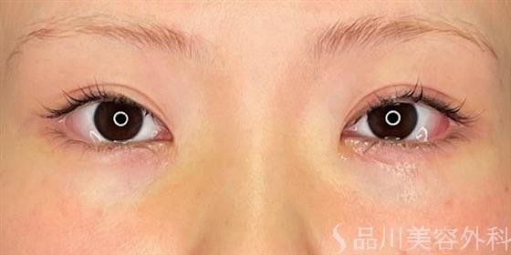 症例NO.51362のAFTER写真