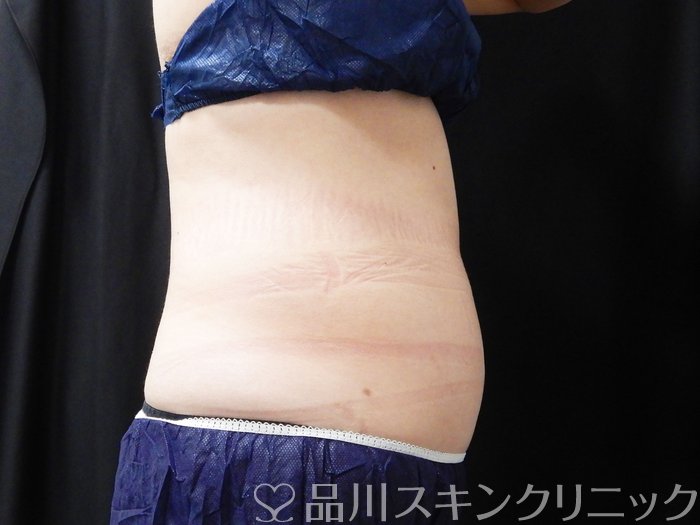 症例NO.74998のBEFORE写真