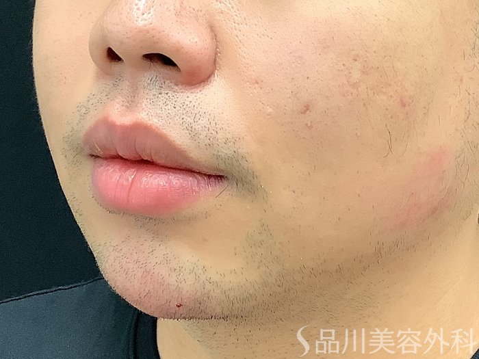 症例NO.67909のAFTER写真